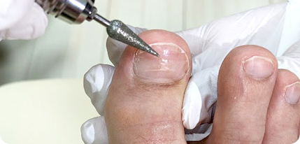 巻き爪ケアの流れ3〜爪の掃除と補正具〜