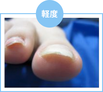 巻き爪度数「軽度」