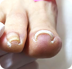 巻き爪BEFORE写真1