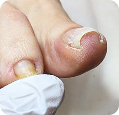 巻き爪BEFORE写真2