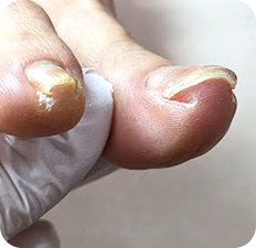 巻き爪AFTER写真2