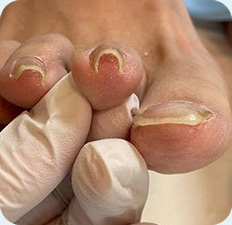 巻き爪BEFORE写真