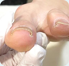 巻き爪BEFORE写真