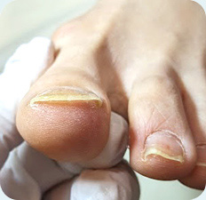 巻き爪AFTER写真