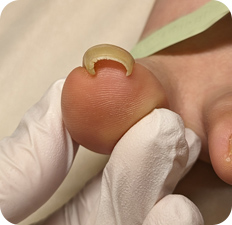 巻き爪BEFORE写真