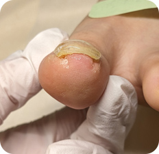 巻き爪AFTER写真