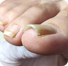 巻き爪BEFORE写真