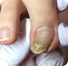 巻き爪BEFORE写真