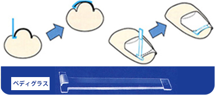 巻き爪治療の特長1